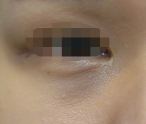 대구 콜라겐주사, 눈밑 꺼짐과 다크서클까지 개선할 수 있을까?
