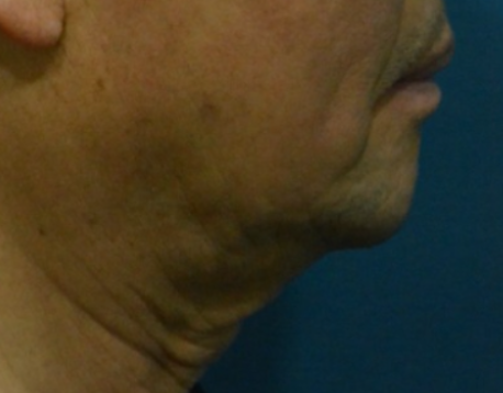대구 실리프팅, 60대와 20대의 리프팅은 다른 이유?(실제 시술 후기) 대표 이미지