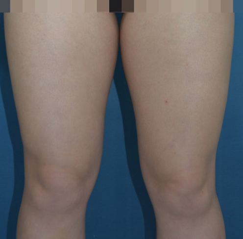 대구 지방흡입, 허벅지 사이즈 감소를 원했던 20대 여성 사례 대표 이미지