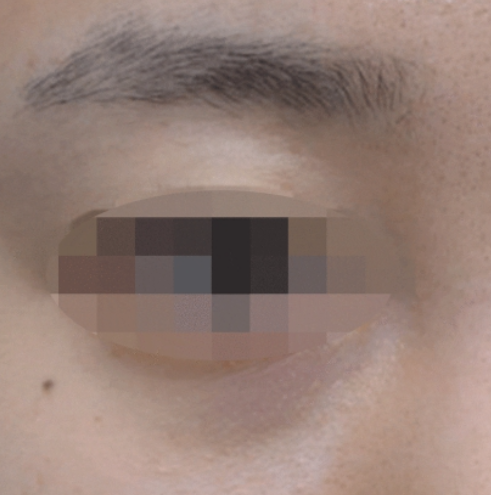 대구 눈밑필러, 눈밑 꺼짐과 다크서클이 심했던 여성 환자 후기 대표 이미지