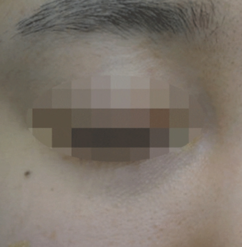 눈밑꺼짐필러 시술 직후 눈밑 꺼짐과 다크서클 비교 사진