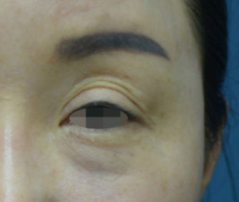 눈두덩이 꺼짐과 두겹 쌍꺼풀, 대구 상안검 수술 케이 대표 이미지
