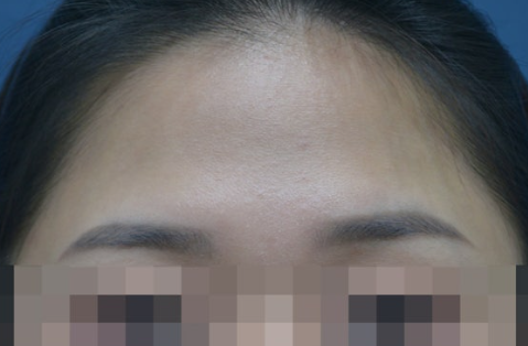 대구 이마필러 4cc 전후, 시술 전 디자인을 먼저 보는 이유 대표 이미지