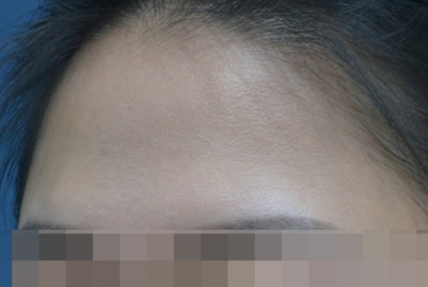이마필러 시술 전 이마 라인과 중심부 함몰을 확인하는 사진