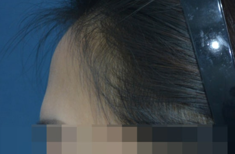 이마필러 시술 전 이마 라인과 중심부 함몰을 확인하는 사진
