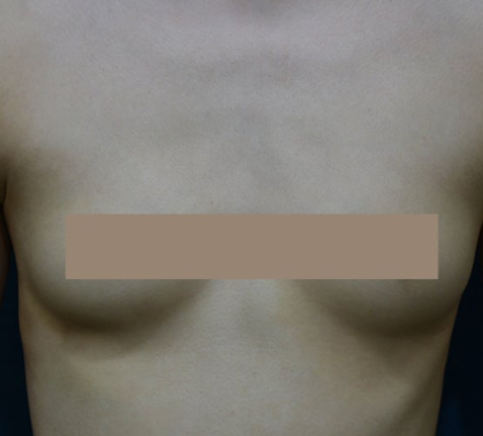 가슴필러, 가슴성형 대신 선택할 수 있을까? 효과·한계·부작용 정리